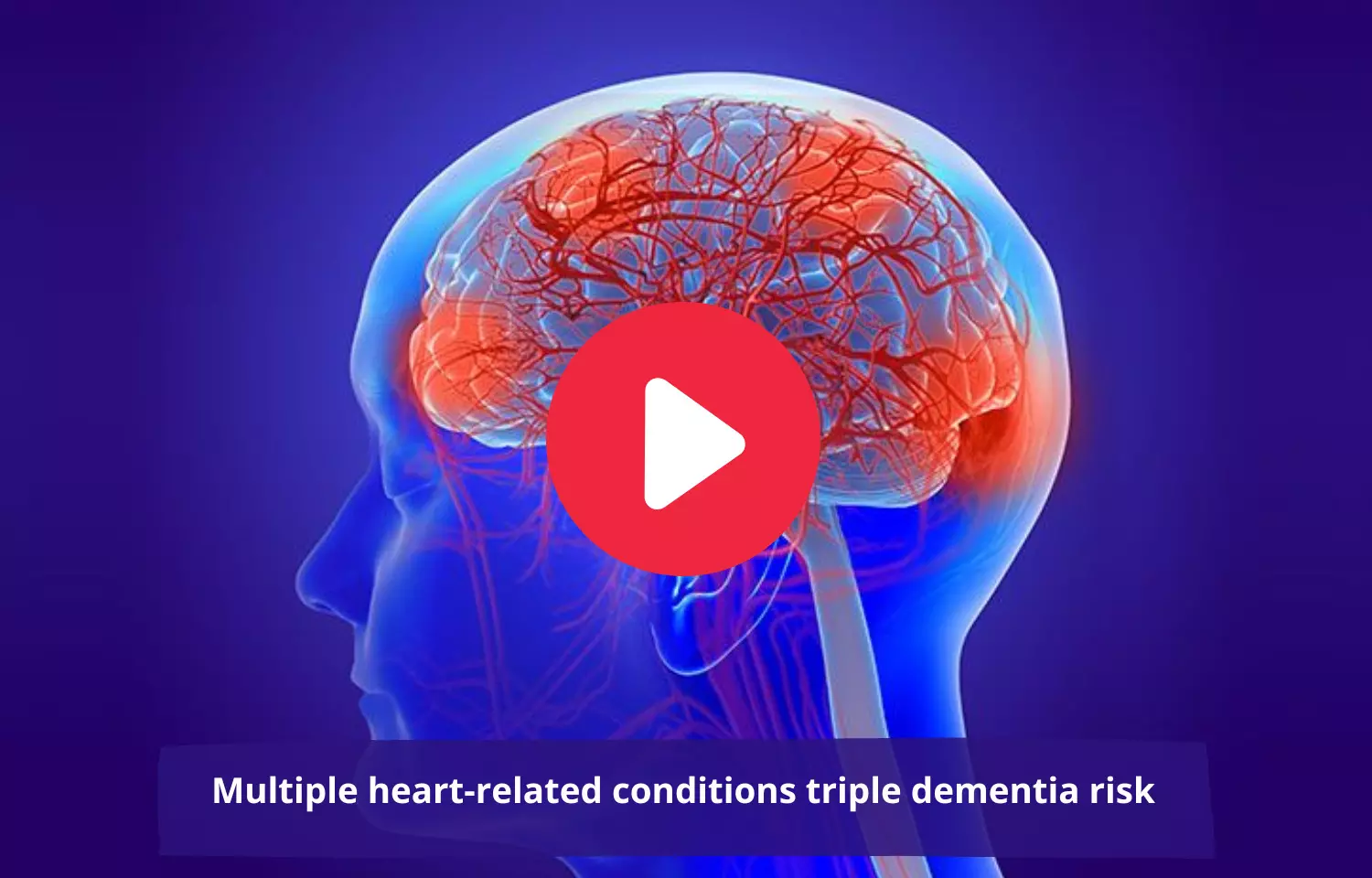 Multiple heart-related conditions triple dementia risk