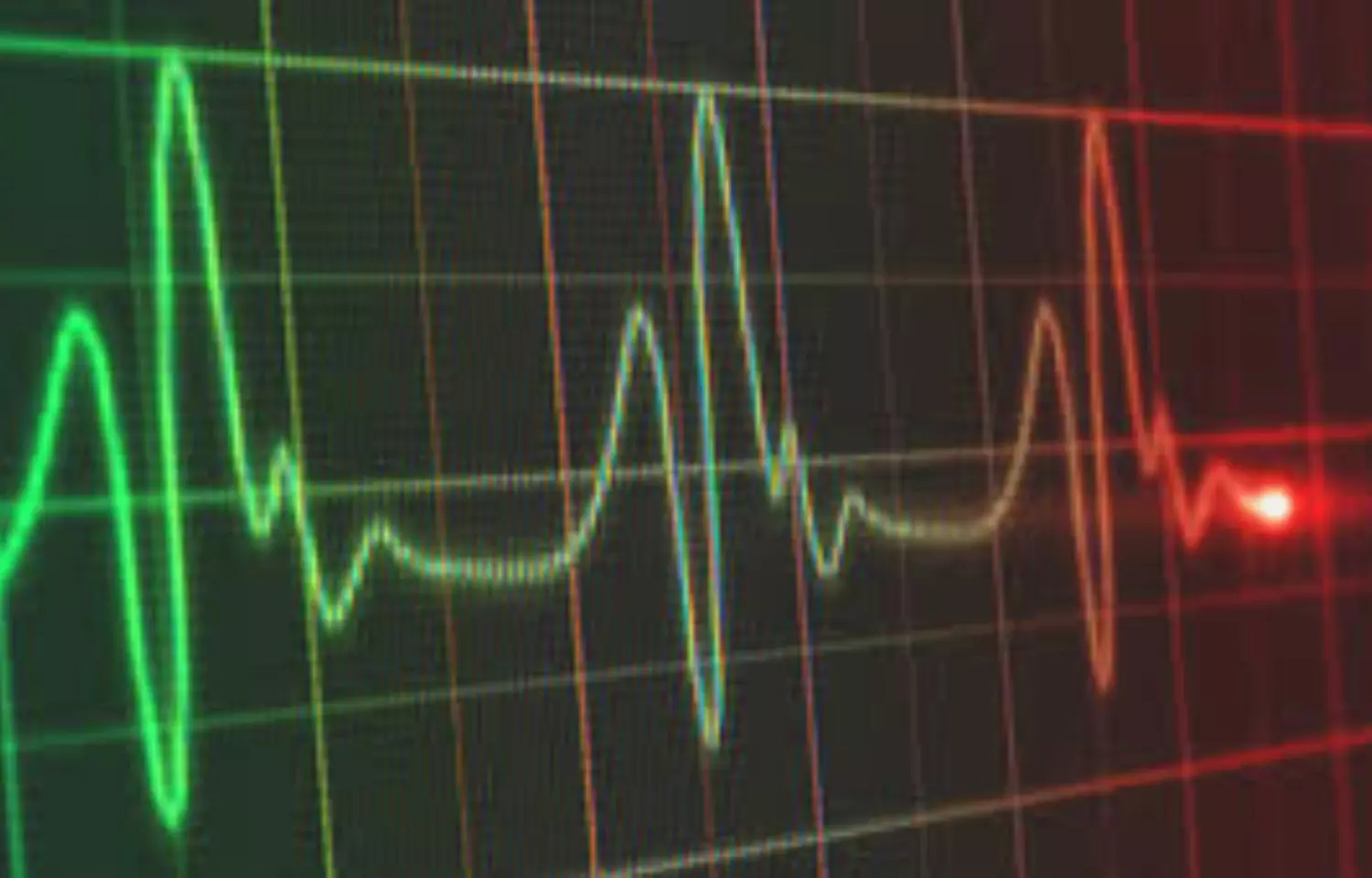 Catheter ablation underused as first-line therapy for  supraventricular tachycardia: JAHA