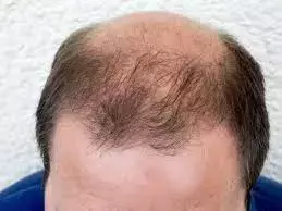 Concentrated growth factor effective in patients with androgenic alopecia