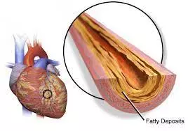 Triglyceride glucose index associated with CAD severity in patients with CHD