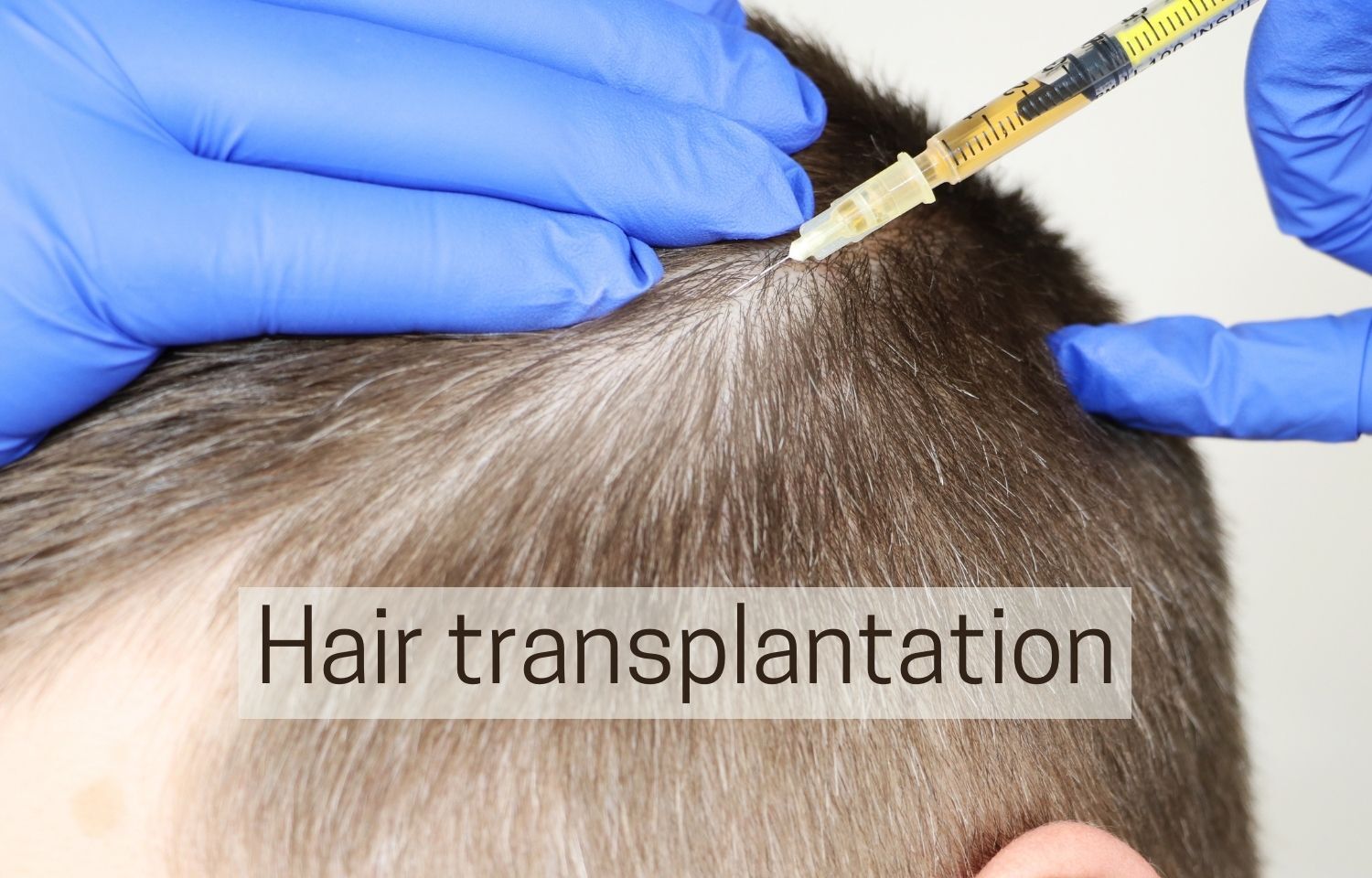 Hair Transplantation facility told to refund after denying surgery to  Diabetic patient