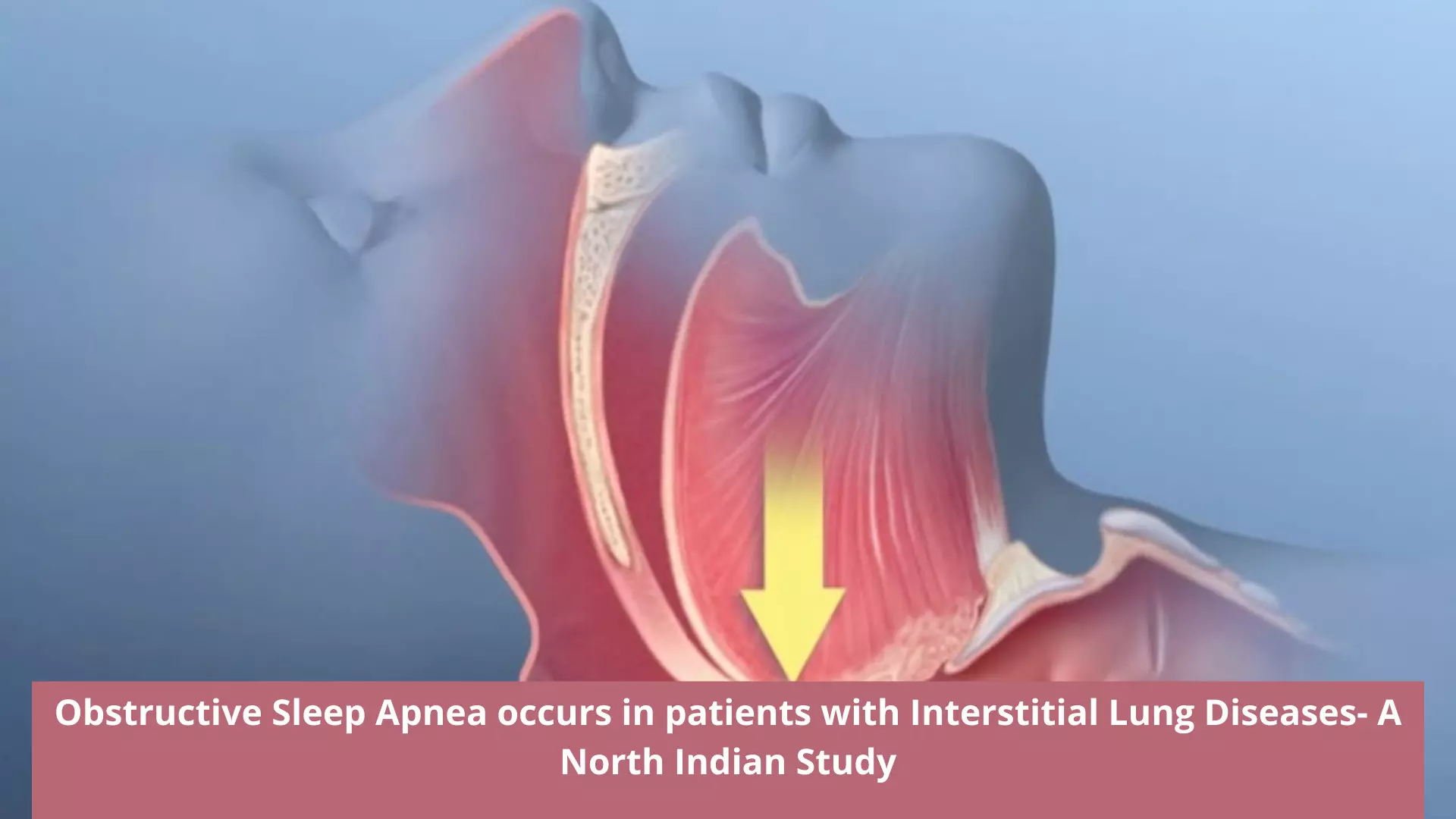 Obstructive Sleep Apnea occurs in patients with Interstitial Lung Diseases- A North Indian Study