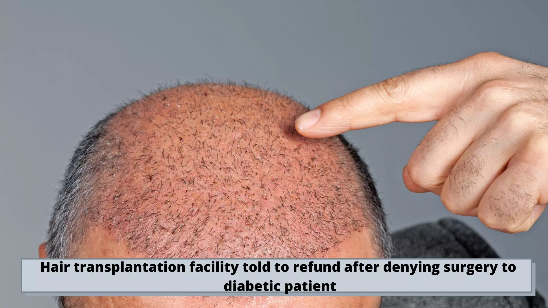 Bengaluru-based Hair Transplantation Facility directed to refund after denying surgery to diabetic patient
