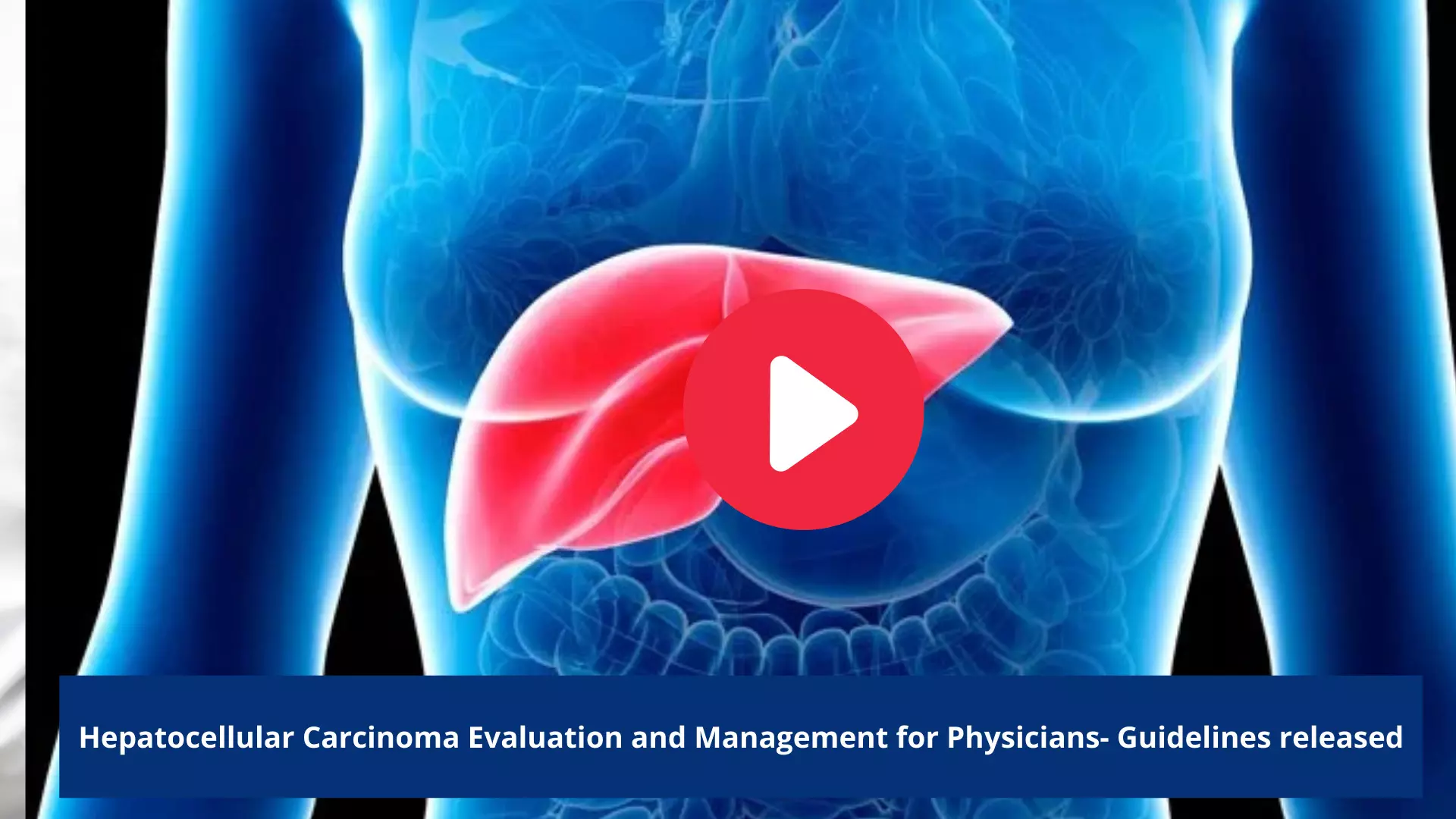 Hepatocellular Carcinoma Evaluation and Management for Physicians- Guidelines released
