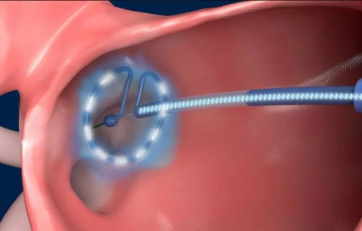 Pulsed-field ablation device allows simple and safe single-shot pulmonary vein isolation in AF: 5 S Study