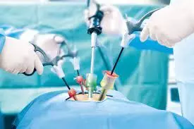 Laparoscopic surgery better than open surgery in treating perforated peptic ulcers: study