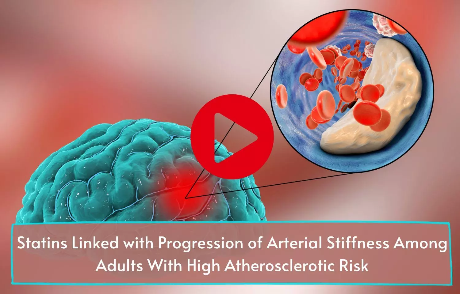 Statins Linked with Progression of Arterial Stiffness Among Adults With High Atherosclerotic Risk