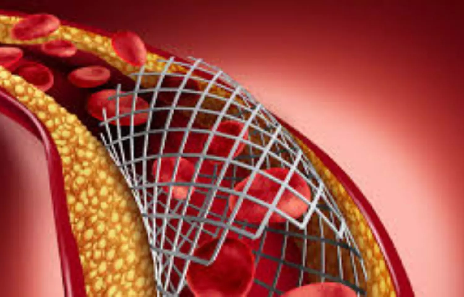 Two-stent strategies of no benefit over provisional stenting for PCI: JAHA