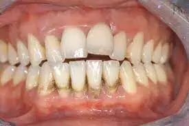 Longitudinal change in periodontal disease status linked with incident diabetes