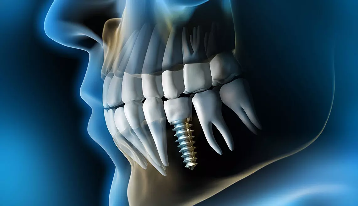 Both deep learning and integrated models perform well in predicting dental implant fate