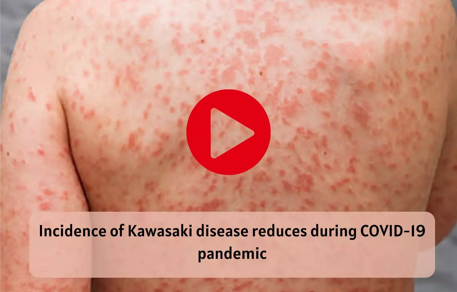 Incidence of Kawasaki disease reduces during COVID-19 pandemic