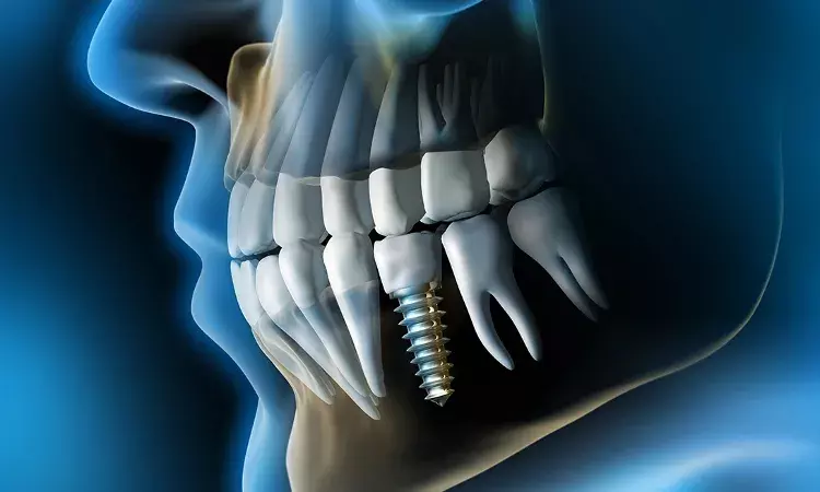 Both deep learning and integrated models perform well in predicting dental implant fate