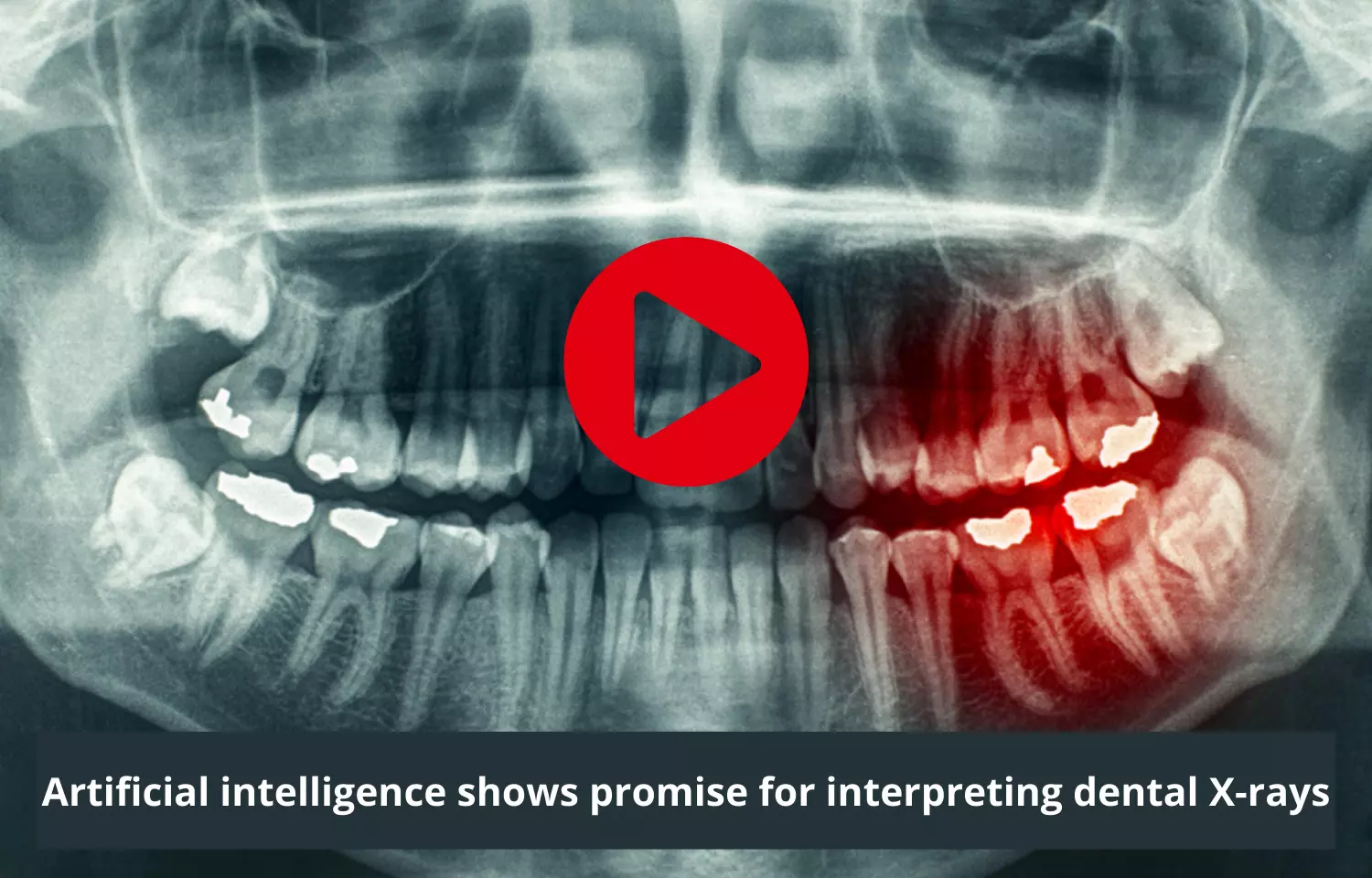 Artificial intelligence shows promise for interpreting dental X-rays