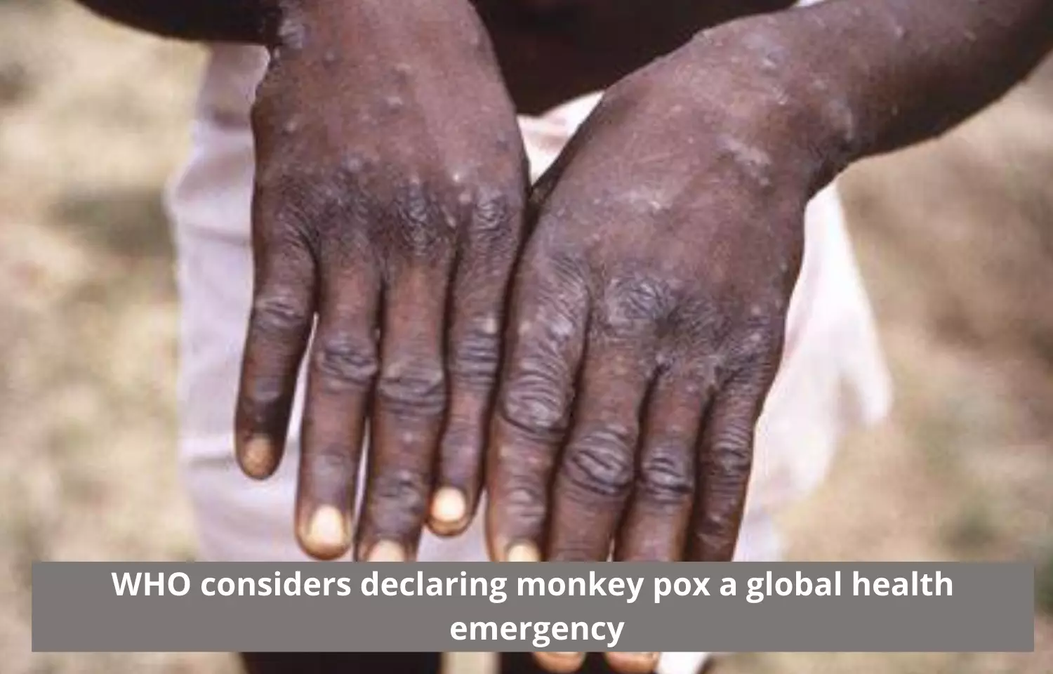 WHO considers declaring monkey pox a global health emergency
