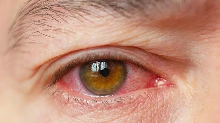 Transplantation of salivary glands may help relieve symptoms of severe dry eye disease
