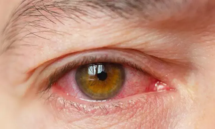 Dry eye Disease A consequence of aging, study finds