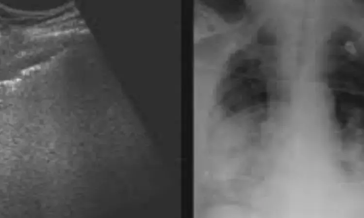 Lung ultrasound may guide about duration of Intibiotic therapy in ventilator-associated pneumonia