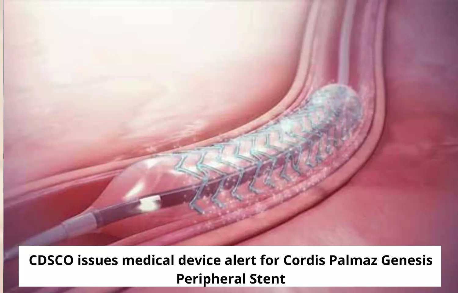 CDSCO issues medical device alert for Cordis Palmaz Genesis Peripheral Stent