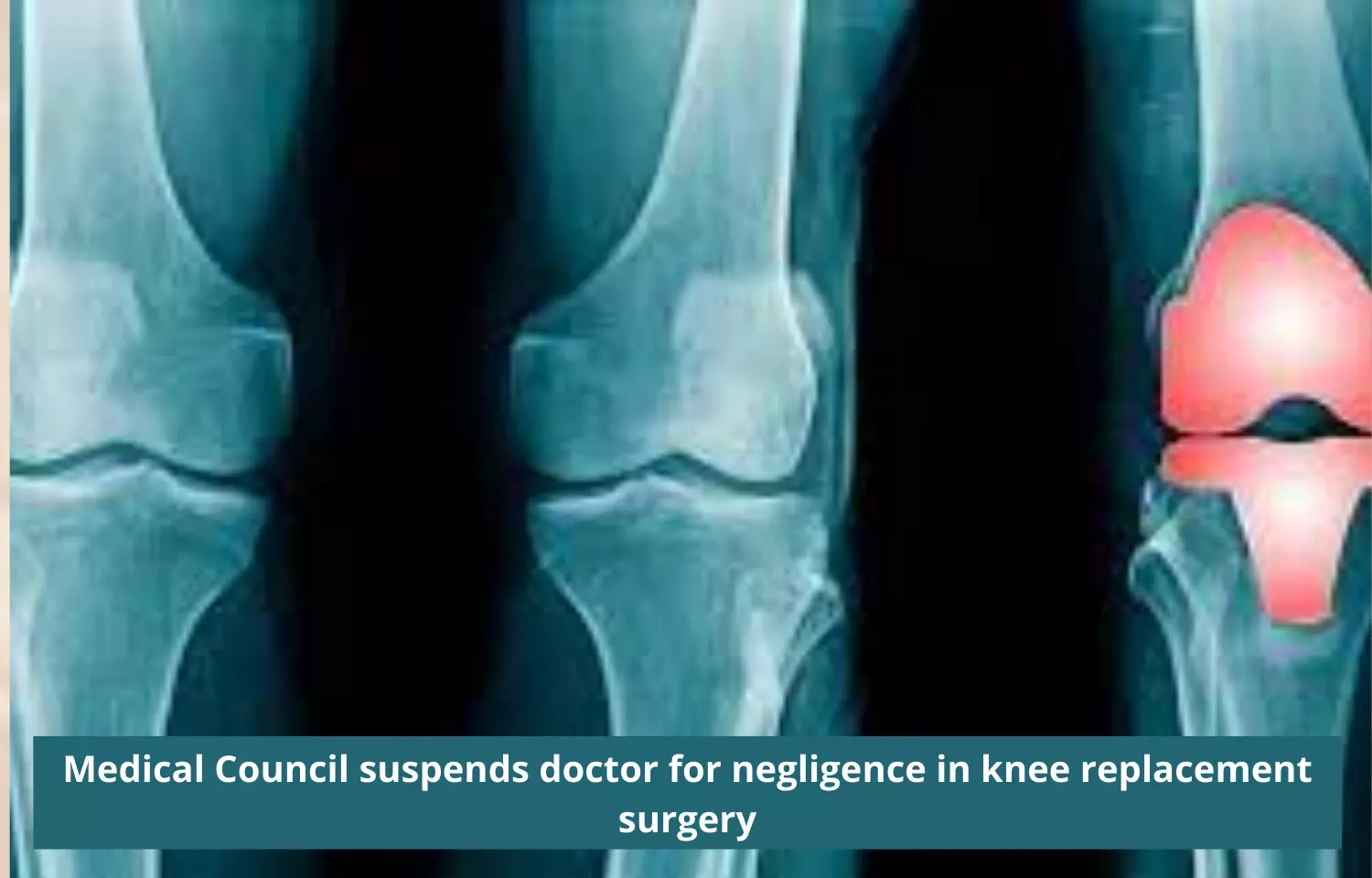 Negligence in knee replacement surgery: Medical Council suspends doctor for 6 months