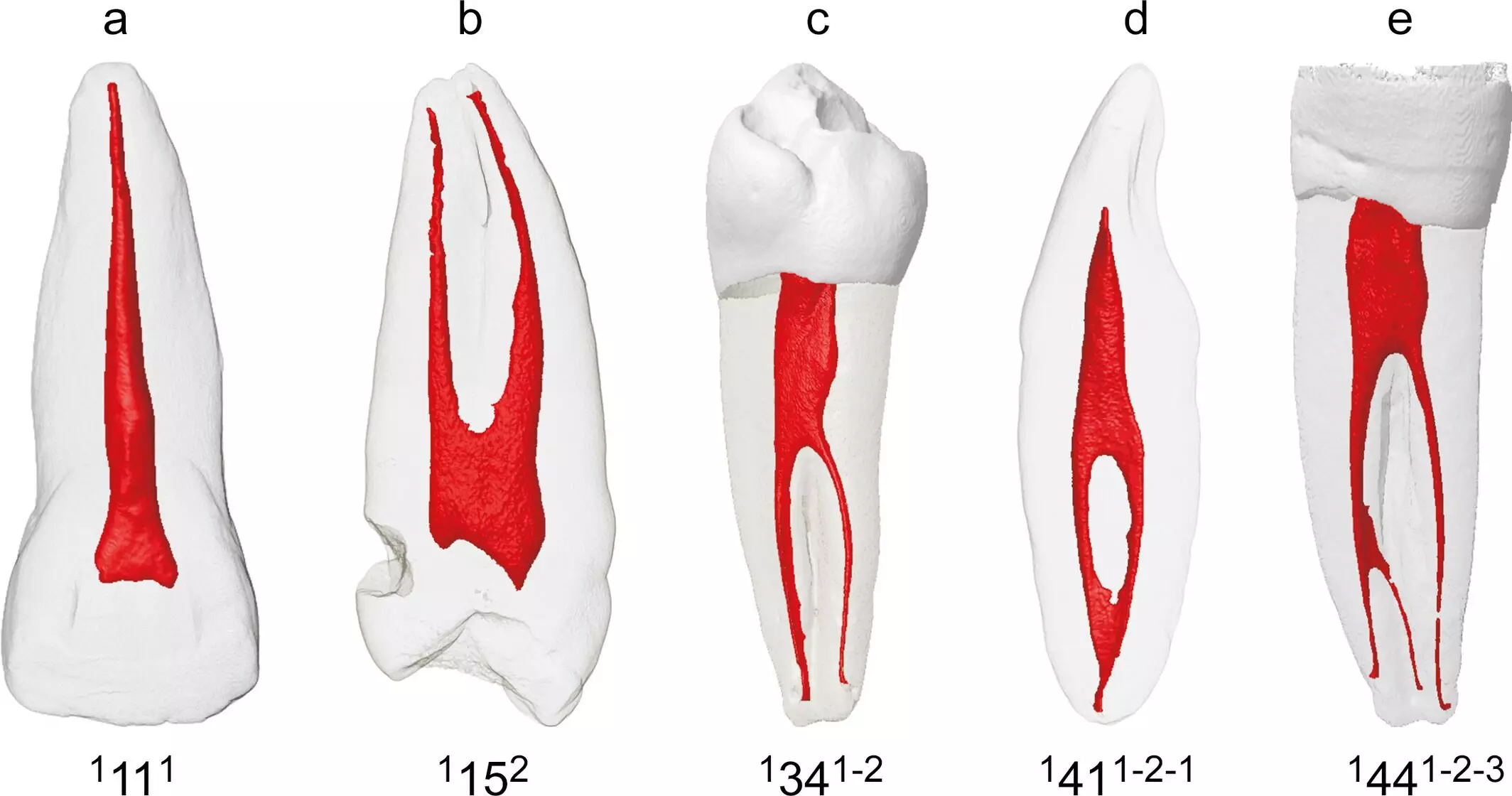 Root canal anatomy of mandibular incisors and mandibular canines varies by ethnicity: study
