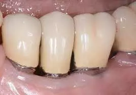 Murine dental implants associated with dysregulated local immunity and risk of peri-implantitis