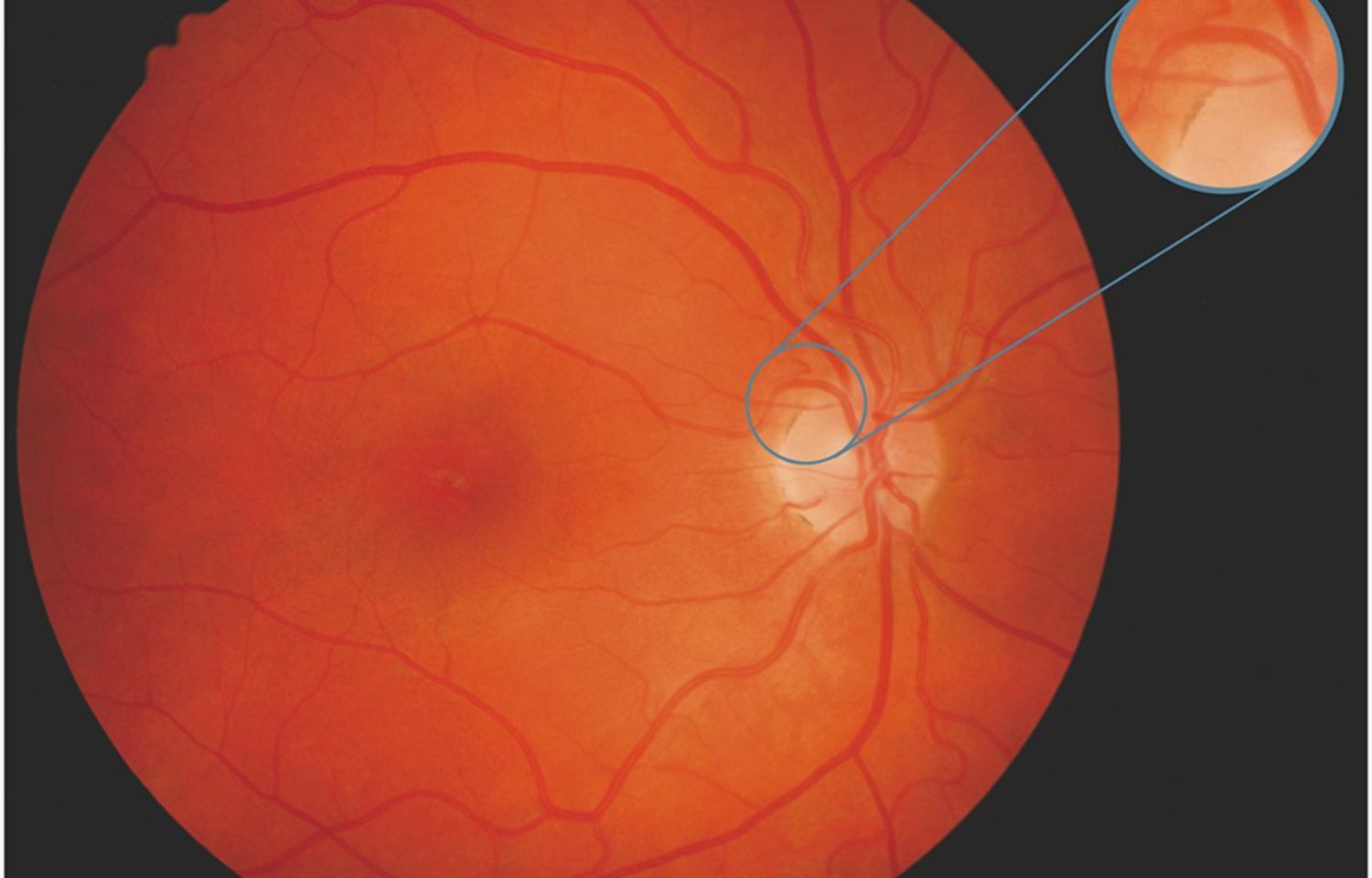 portable-fundus-photography-more-accurate-than-smartphone-fundoscopy