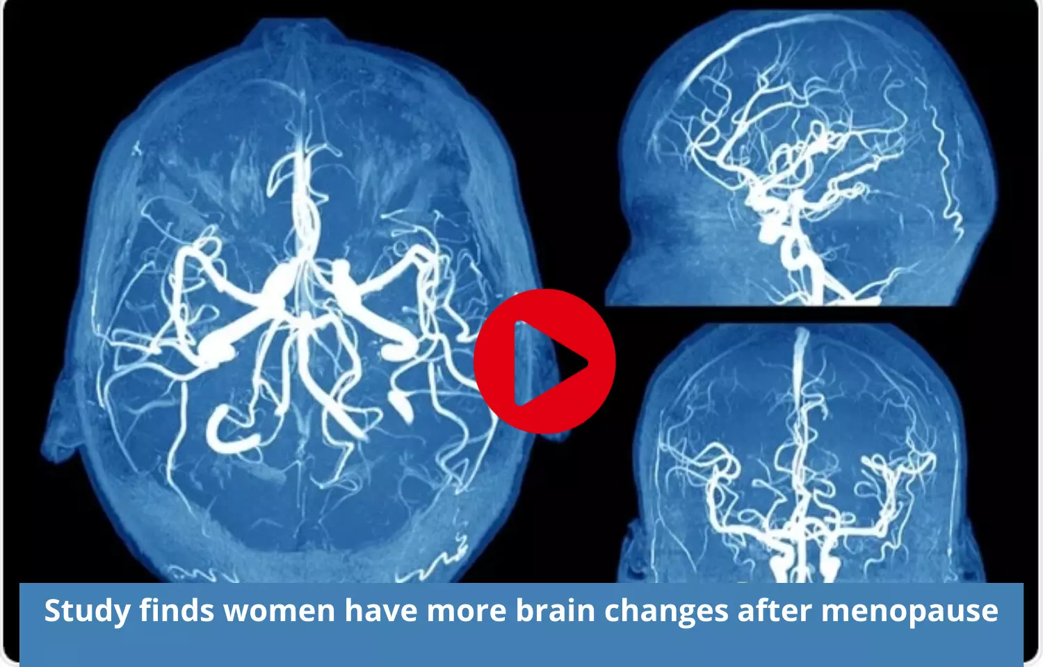 Women to have more brain changes after menopause