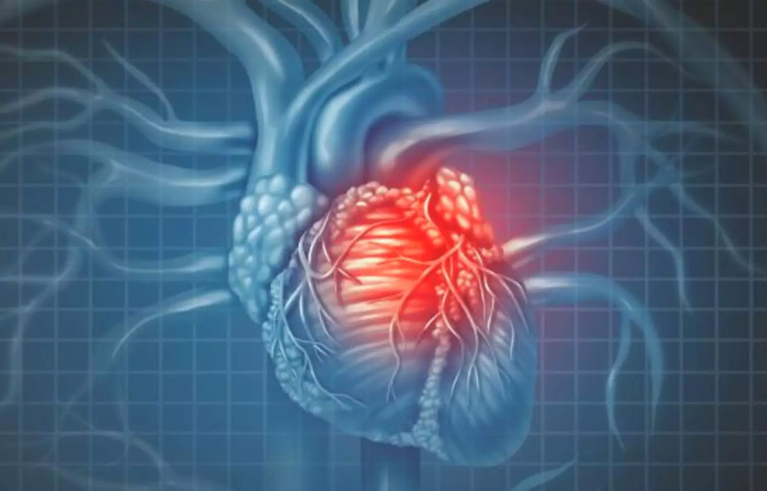 Invasive management of chronic coronary disease not tied to QoL benefit in patients with CKD
