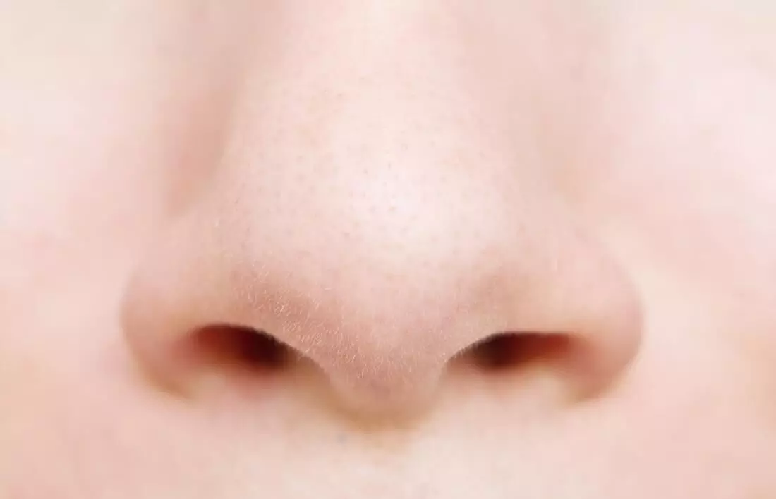 Rare case of a concealed kind of supernumerary nostril: a report