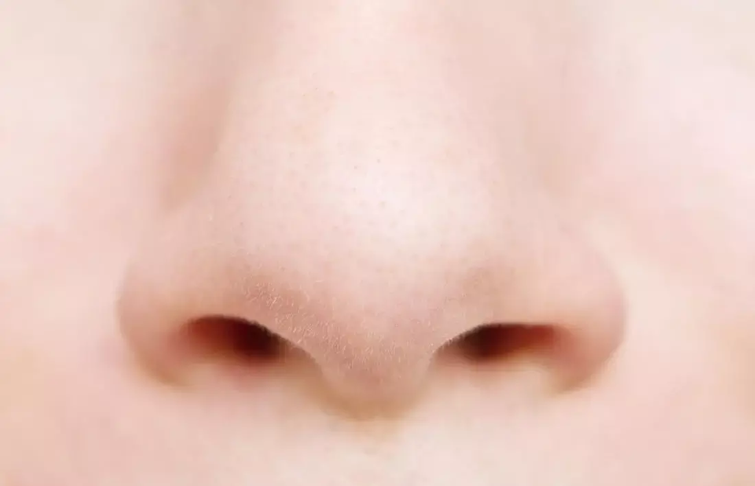 Rare case of a concealed kind of supernumerary nostril: a report