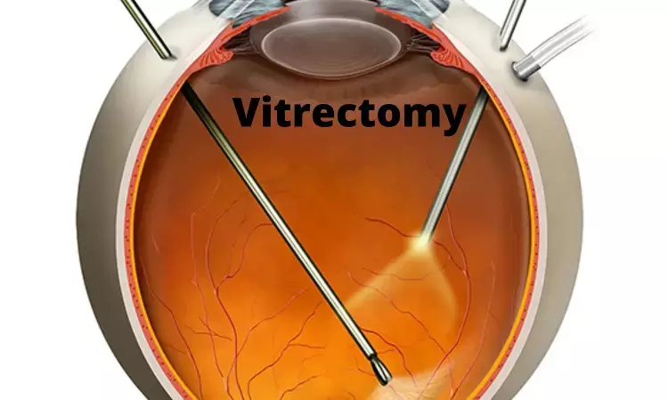 Vitreous opacity vitrectomy safe and effective for removal of Floaters: Study