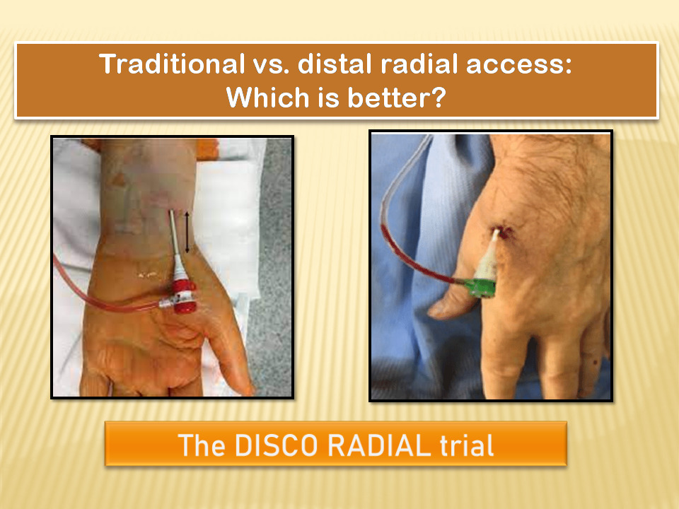 Distal Radial Access Not Better Than Conventional Approach In Preventing Radial Artery Occlusion