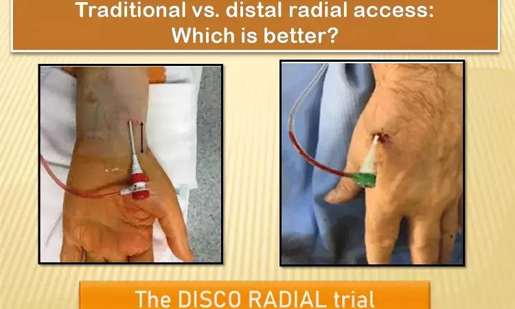 Distal radial access not better than conventional approach in preventing radial artery occlusion, DISCO RADIAL trial.