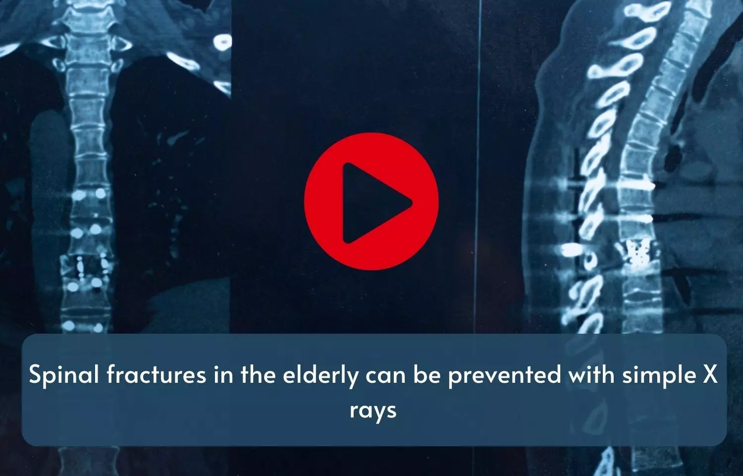 Spinal fractures in the elderly can be prevented with simple X-rays