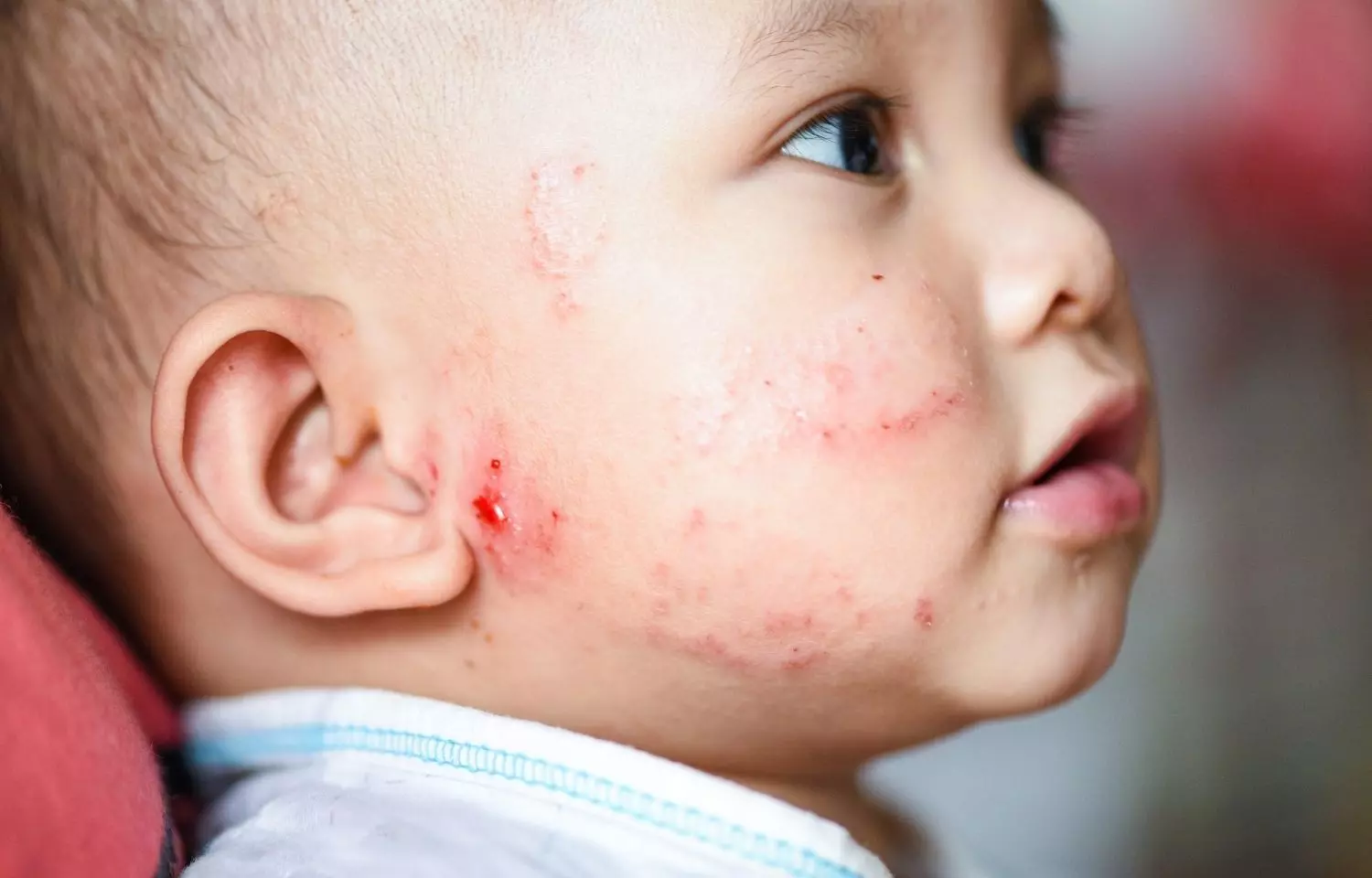 Maternal antenatal vitamin D supplementation lowers risk of eczema in babies