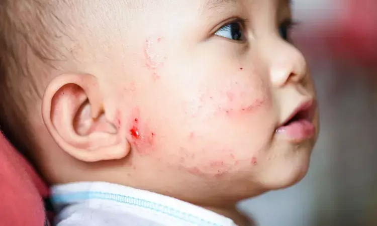 Maternal antenatal vitamin D supplementation lowers risk of eczema in babies