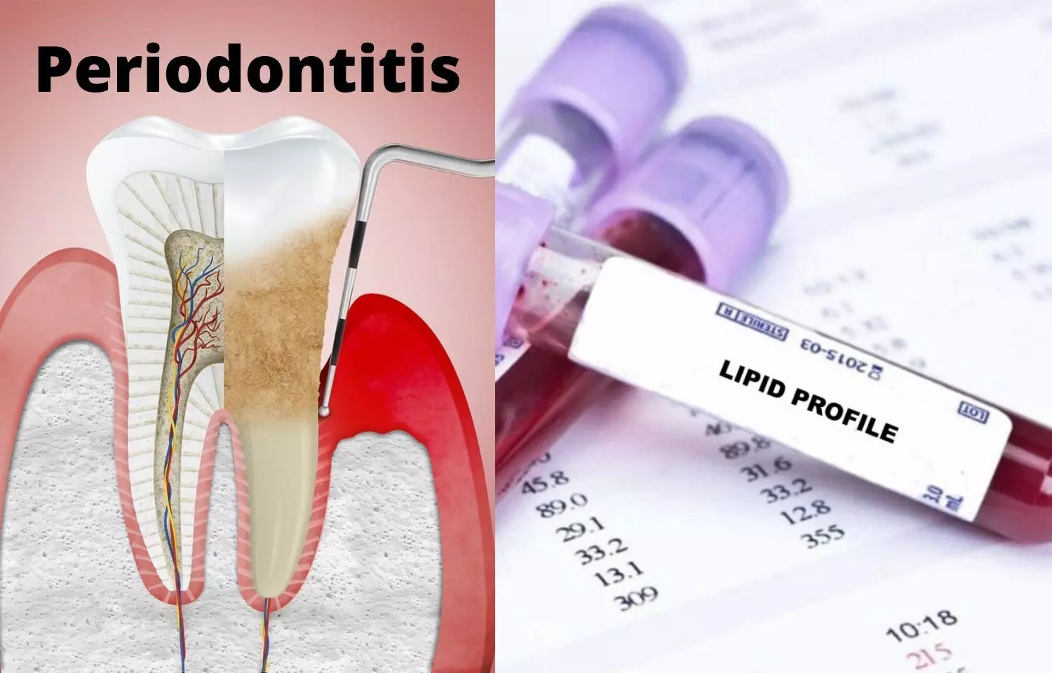 Periodontitis tied to increased risk of dyslipidemia: Study