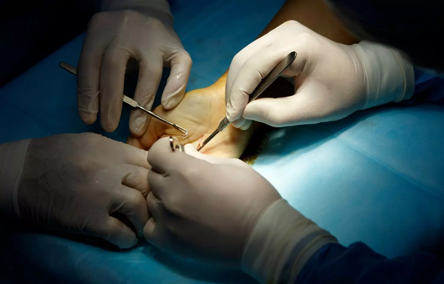 Overall risks of shoulder surgery low, but study finds significant risk of reoperation