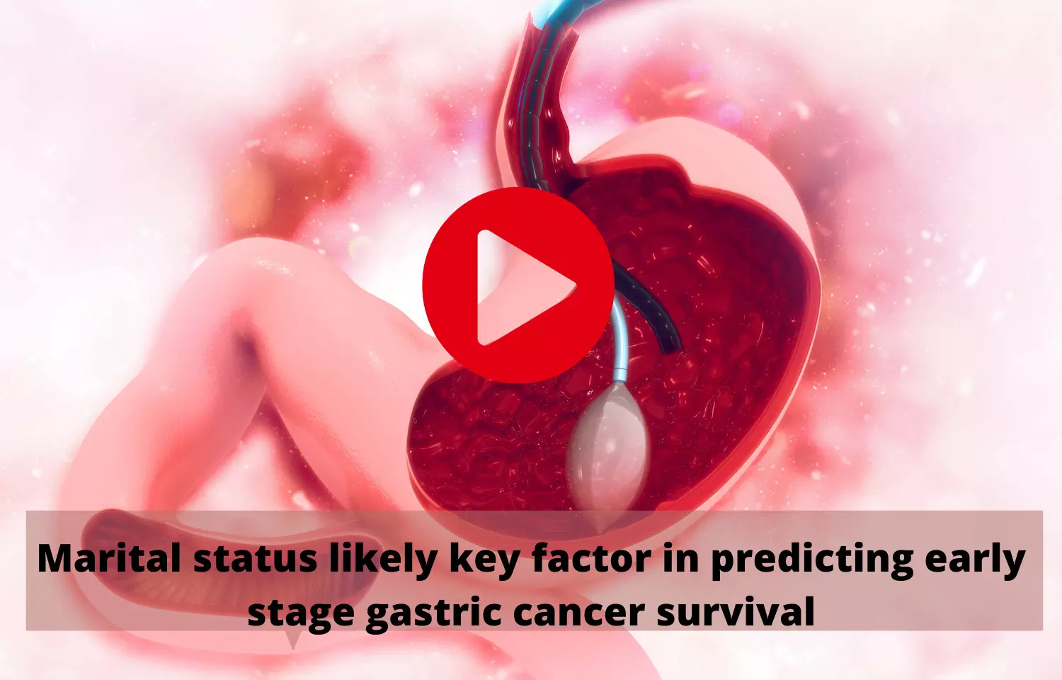 Marital status likely key factor in predicting early stage gastric cancer survival