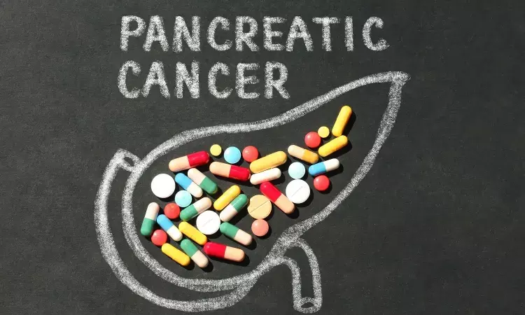 AI applied to prediagnostic CTs may help diagnose pancreatic cancer at earlier stage
