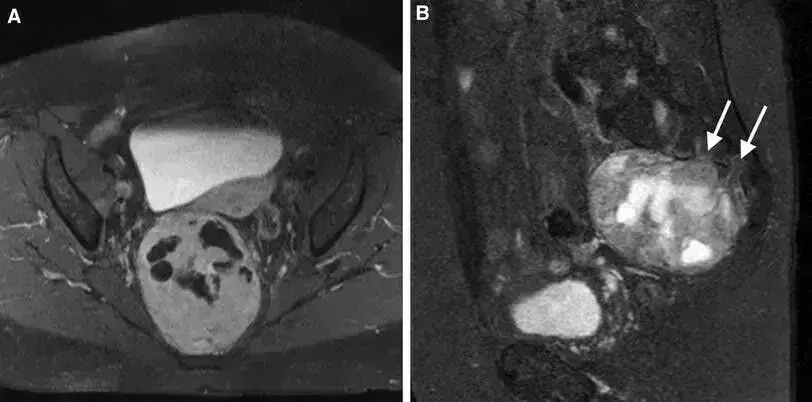 Rare case of Retrorectal Schwannoma-study of a diagnostic and therapeutic challenge