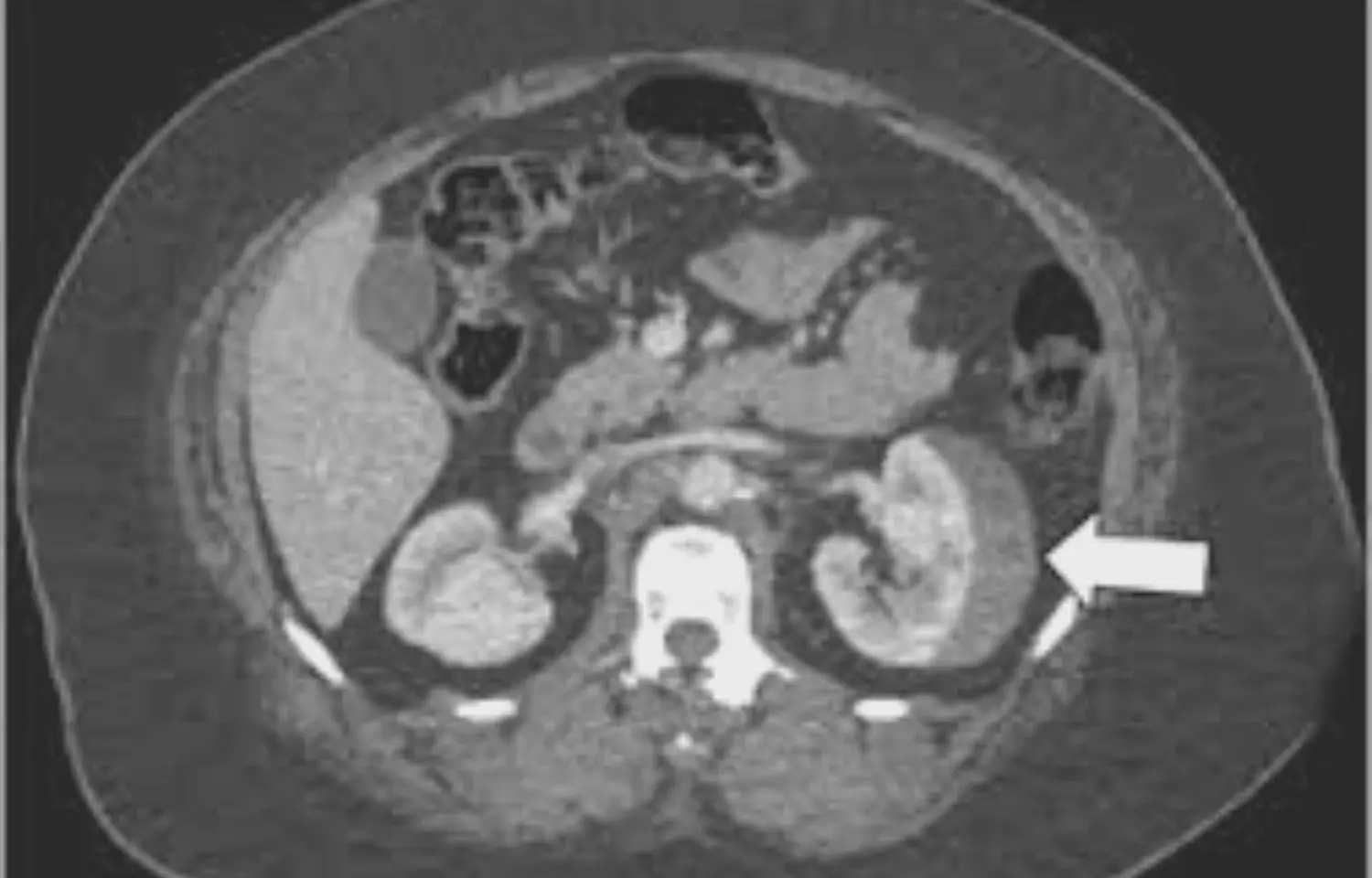 Repeat CT imaging can be safely omitted in uncomplicated blunt renal injuries: Study