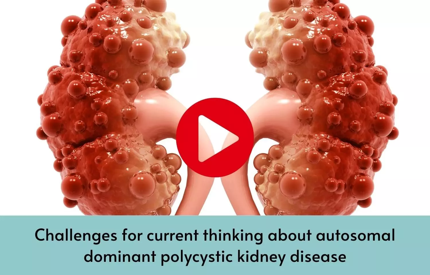 Challenges for current thinking about autosomal dominant polycystic kidney disease