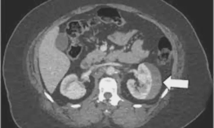 Repeat CT imaging can be safely omitted in uncomplicated blunt renal injuries: Study