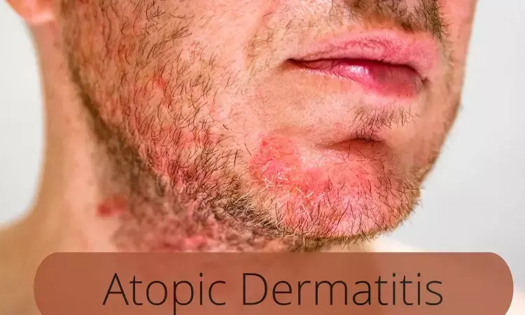 Cold atmospheric plasma- promising treatment of atopic dermatitis