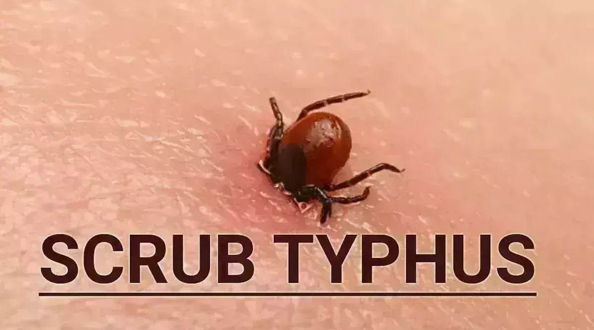 West Bengal opens 44 sentinel labs for Scrub Typhus