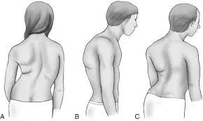 Rare case of Pectus excavatum, kyphoscoliosis associated with thoracolumbar spinal stenosis reported