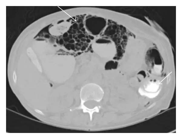 Case of Acute abdomen with gastric volvulus due to pneumatosis cystoides intestinalis:  A report