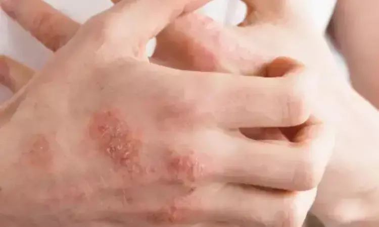 Domestic hard water increases eczema prevalence in adults: Study
