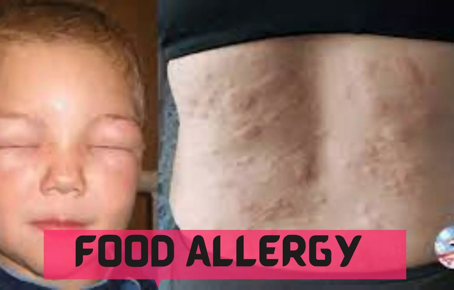 Atopy Patch Test may help identify and diagnose food allergies in Children